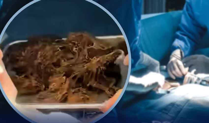 چین میں لڑکی کے معدے سے 2 کلو بالوں کا گچھا نکال لیا گیا