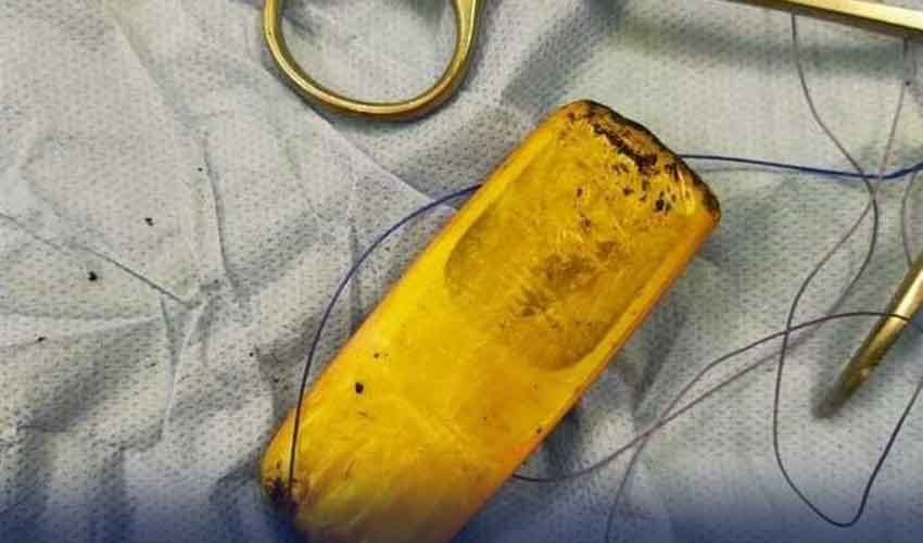 ڈاکٹروں نے سرجری کے ذریعے مریض کے معدے سے موبائل فون نکال لیا