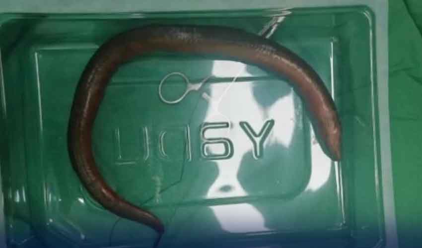 ڈاکٹروں نے شہری کے پیٹ سے ایک فٹ لمبی زندہ بام مچھلی نکال لی